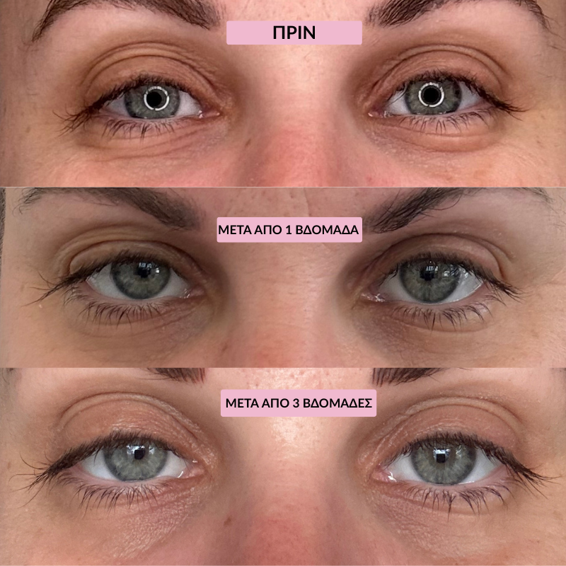 Dark Spot Eye Remover